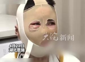 女生拒复合遭前男友泼汽油 全身69%烧伤 面部毁容 凶手一审获刑12年