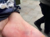 女子小區電梯內被狗咬傷，有業主稱疑為禁養犬種，警方稱后續將發通報