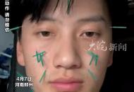 針灸專業(yè)學(xué)生自扎臉美容 計(jì)劃連扎30天測(cè)試改善黑眼圈滿臉是針說(shuō)不痛
