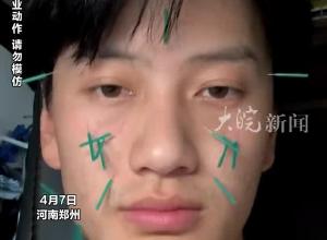 针灸专业学生自扎脸美容 计划连扎30天测试改善黑眼圈满脸是针说不痛