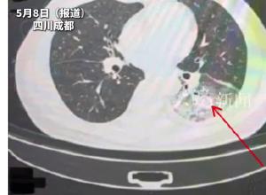 男子吹1年沒開的空調 感染軍團菌肺炎，左肺白了一半