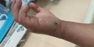 蛇咬傷患者增多 池州已接診十幾例