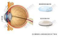 看东西模糊、视力下降？合肥普瑞眼科：小心“潜伏”在眼内的致盲杀手——白内障